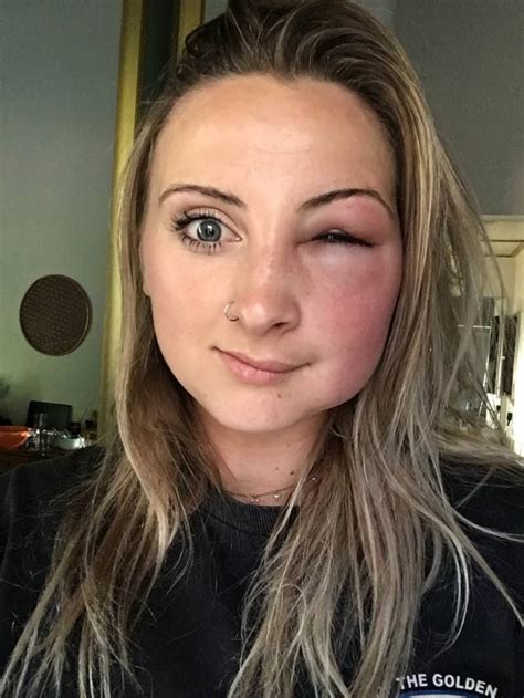 PsBattle: Girl with half her face swollen from a bee sting : r ...