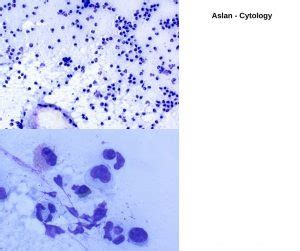 Eosinophilic Granuloma Complex (EGC)