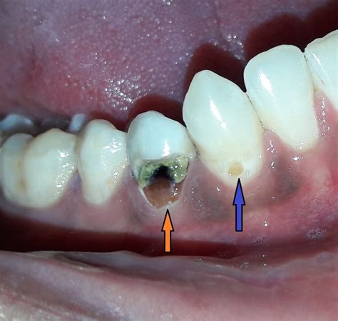 “Say Goodbye to Tooth Decay: Causes, Progression, Prevention and ...