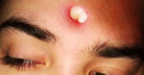 What Are Pimples? Bacteria Filled Sebaceous Glands! #Gross, #Pimple | Sebaceous gland