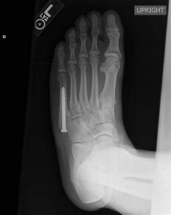 Fifth Metatarsal Fracture – Jones fracture | Dr. David Geier - Sports Medicine Simplified