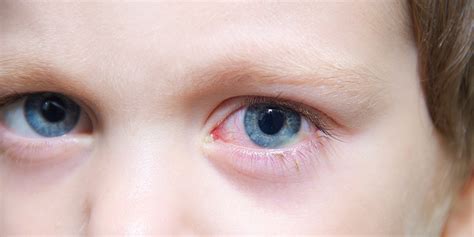 Pink Eye: Causes, Symptoms, Risks, and Treatment - Anaheim Eye Institute