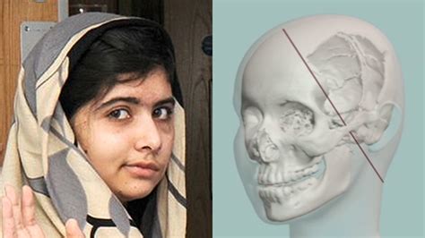 How doctors will repair Malala Yousafzai’s skull – Channel 4 News