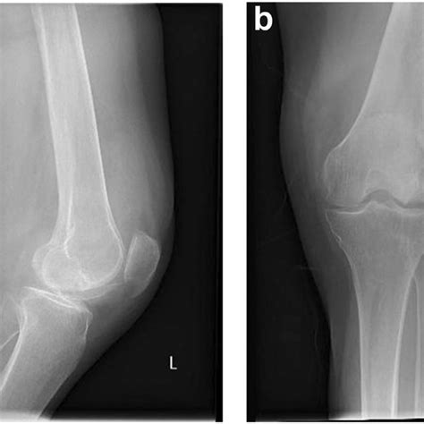 (PDF) A Case of Subchondral Insufficiency Fracture of the Knee at Lateral Femoral Condyle ...