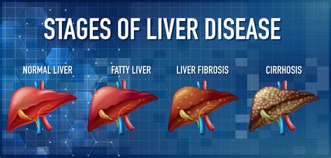 Common liver diseases: Discussing some of the most common liver diseases, such as hepatitis ...