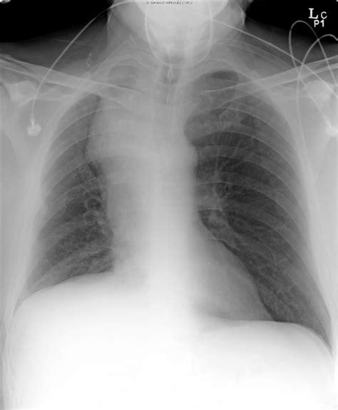 Chest radiograph shows a mass-like lesion in the right paratracheal ...