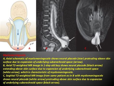 Myelocele. A, Axial schematic of myelocele shows neural placode (arrow ...