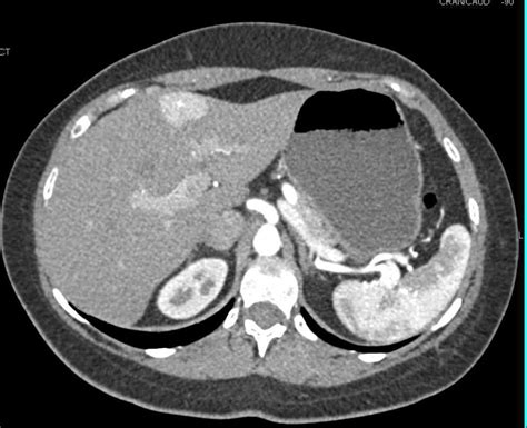 Focal Nodular Hyperplasia (FNH) - Liver Case Studies - CTisus CT Scanning