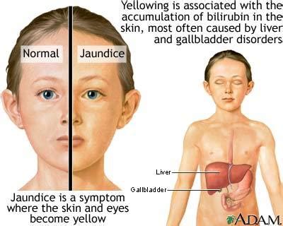 Jaundice Symptoms and causes | Medical Laboratories