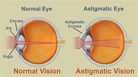 Glaucoma Agudo Consecuencias Astigmatism Glaucoma Swollen Eyes Disease ...