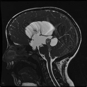 Preoperative T2-weighted sagittal MRI scan showing third ventricle... | Download Scientific Diagram