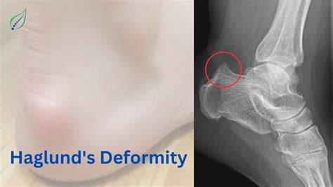 Haglund’s Deformity: Causes, Symptoms, and Treatment Options | Best Back Pain, Slip Disc, Knee ...