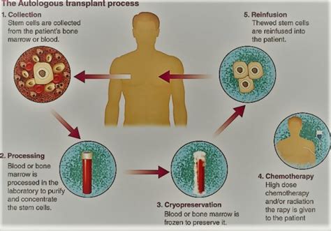 Bone Marrow Transplant: Type, Risks, Preparation, Procedure, Cost, Recovery