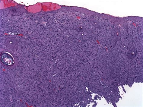 Metastatic atypical fibroxanthoma