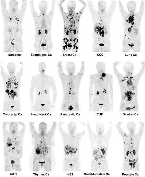 New radiotracer can identify nearly 30 types of cancer