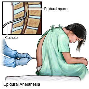 Epidural Anesthesia - What You Need to Know