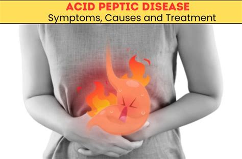 Acid Peptic Disease: Symptoms, Causes and Treatment - Digestive ...