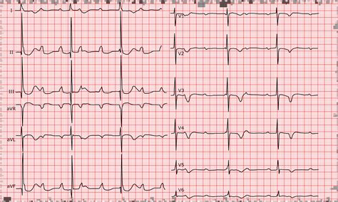 [Cardio-FR] Complete A-V block. Right atrial enlargement.