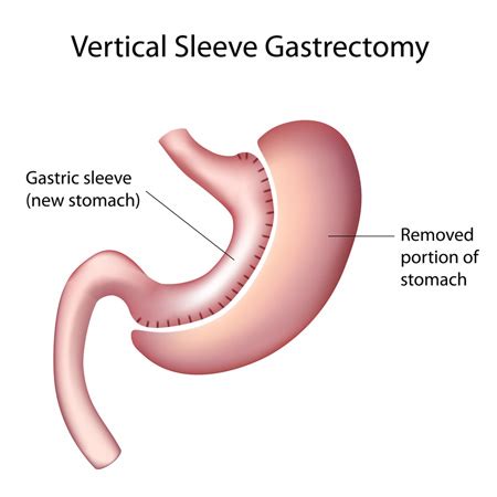 Gastric Sleeve, Sleeve Gastrectomy, VSG (Vertical Sleeve Gastrectomy ...