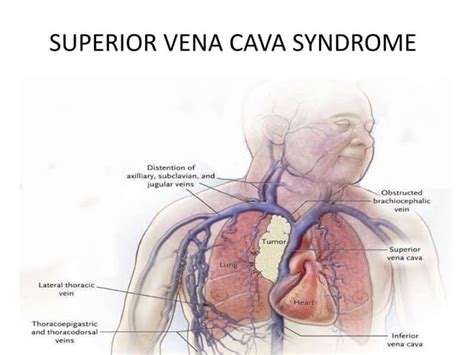 Superior vena cava syndrome | PPT