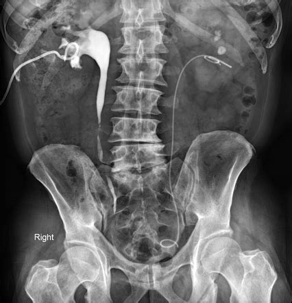 Ureteral stricture - nephrostogram | Radiology Case | Radiopaedia.org