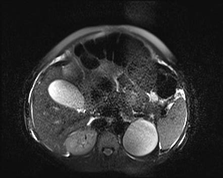 Sigmoid Volvulus Mri