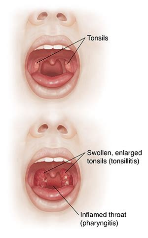 When Your Child Has Pharyngitis or Tonsillitis | Saint Luke's Health System