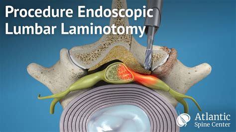 Procedure Endoscopic Lumbar Laminotomy - YouTube