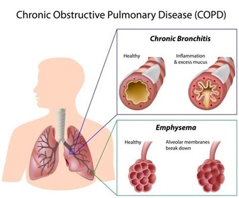 COPD: Causes, Symptoms, and Treatment