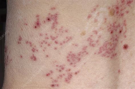 Shingles rash - Stock Image - M260/0359 - Science Photo Library