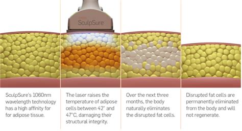 SculpSure Fat Reduction | Auburn, WA | Luma Med Spa