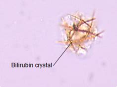 Bilirubin crystals in hepatic disorders | Medical Laboratories