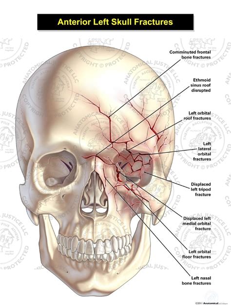 Anterior Left Skull Fractures