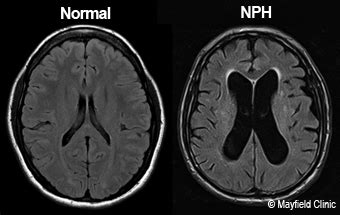 Normal Pressure Hydrocephalus