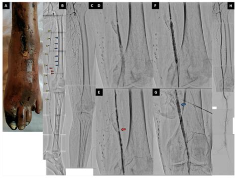 Balloon-Expandable Covered Stent to Superficial Femoral Artery