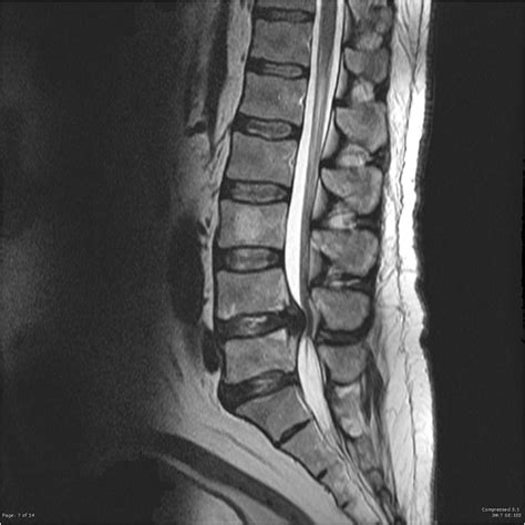 Cauda Equina Syndrome - REBEL EM - Emergency Medicine Blog