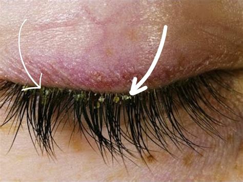 Lash Extensions and Lash Mites: Keep Lashes Free Of Infestation