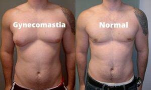 7 Things to Know about Gynecomastia