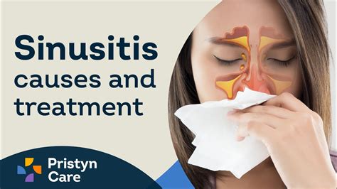 Sinusitis Causes & Treatment - YouTube