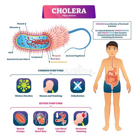 Cholera Stock Illustrations – 1,986 Cholera Stock Illustrations ...