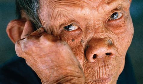 Leprosy (Hansen’s Disease): Causes, Symptoms and Treatments | Healthtian