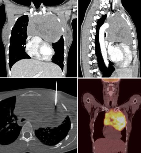 Anterior mediastinal mass - Radiology at St. Vincent's University Hospital