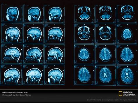 mri brain scan results | Mri Scans | Pinterest | Medical