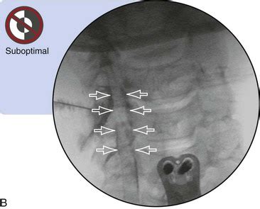 Cervical Transforaminal Epidural Steroid Injection | Radiology Key