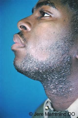 Pseudofolliculitis Barbae - American Osteopathic College of Dermatology (AOCD) #IngrownHairChin ...