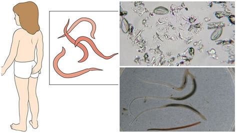 Pinworm worms - photo and description