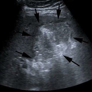 90-year-old male with acute cholecystitis. A. Cholecystogram showing ...