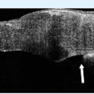 A: ASOCT arrow showing peripheral anterior synechiae near graft host... | Download Scientific ...