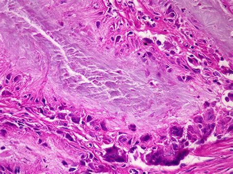 Tophus Histology