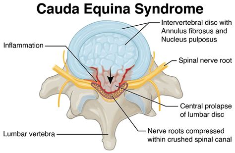 Cauda Equina Syndrome: Symptoms, Causes, Treatment By Back Braces